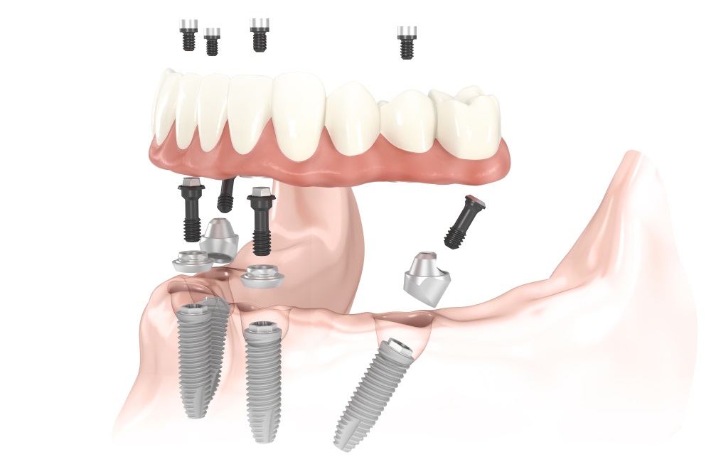 Quels sont les différents types de prothèses dentaires